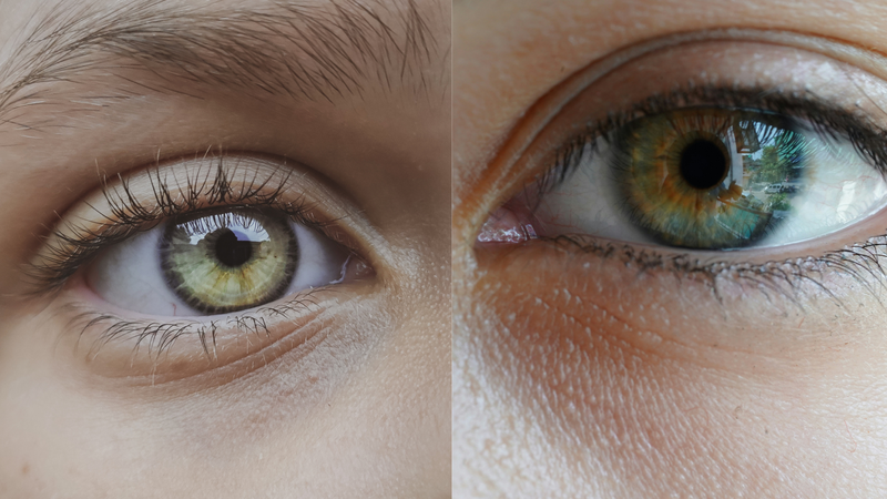 Mắt 3 mí và nỗi lo tâm lý 1