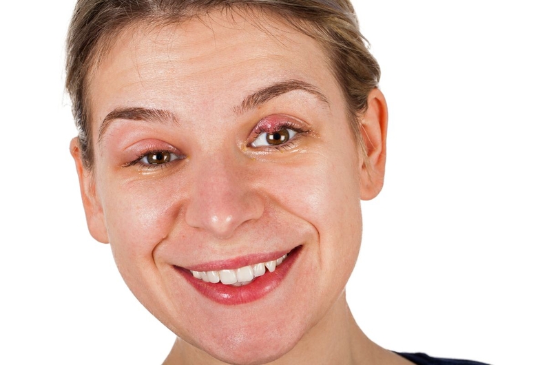 Mắt bị cộm mí trên: Nguyên nhân và cách điều trị 2