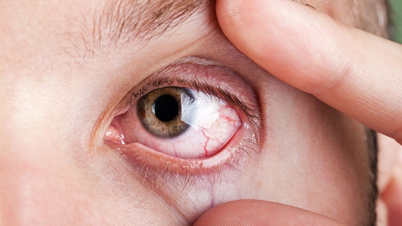 Mắt bị mờ sau khi đeo lens: Nguyên nhân và cách khắc phục 3