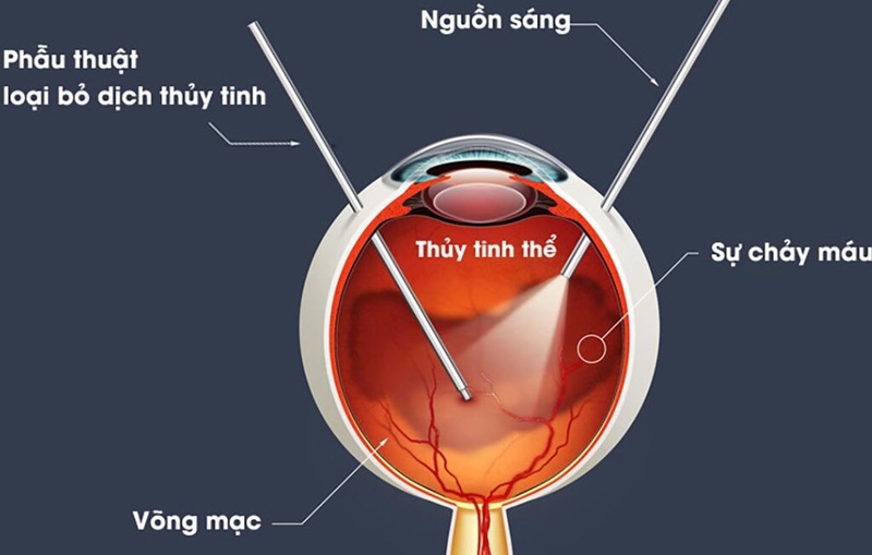 Mắt bị vẩn đục dịch kính: Nguyên nhân, triệu chứng và hướng điều trị 4
