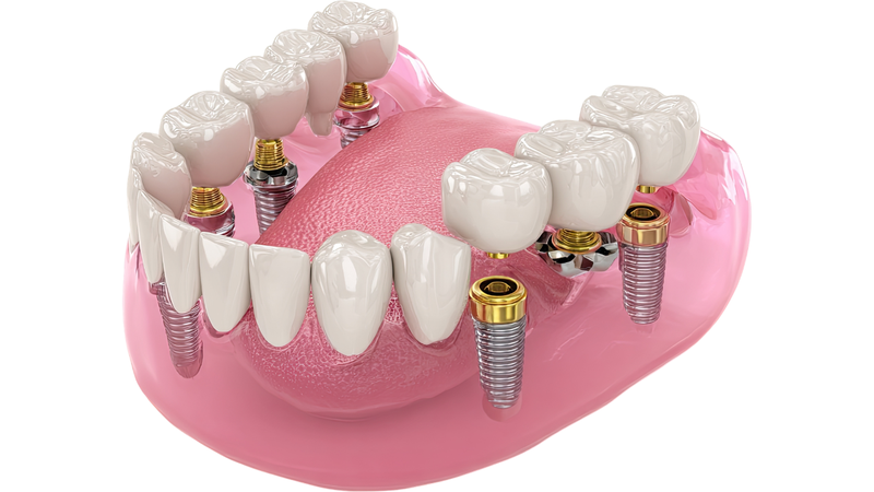 Trồng răng Implant phục hồi khả năng ăn nhai gần tương đương răng thật