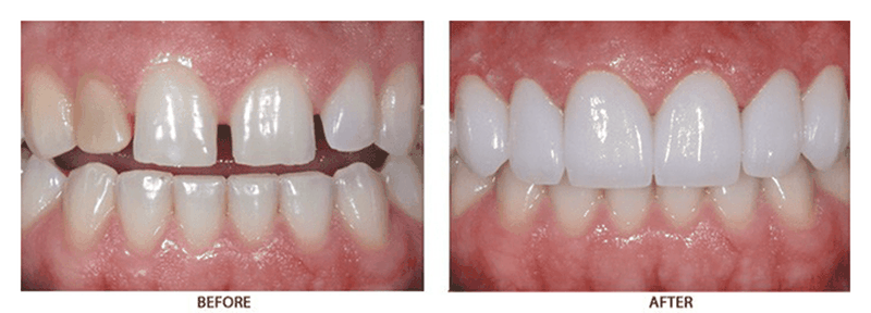 Dán sứ veneer mấy loại và những lưu ý khi dán răng sứ 3