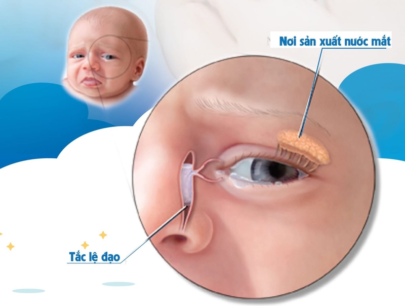 Mắt đổ ghèn sau sinh ở trẻ có nguy hiểm không? 2