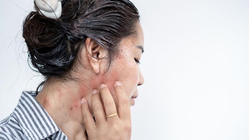 Hạn chế gãi ở vị trí mạt gà cắn để tránh nhiễm trùng thứ phát