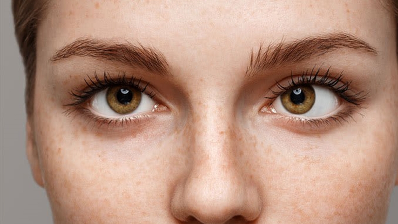 Mắt lé là gì và mắt lé có chữa được không? 3