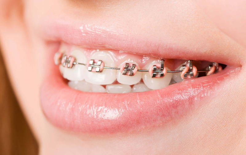 Giải pháp niềng răng có tác động đến mặt lệch