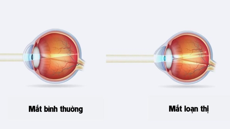 Mắt loạn thị có đeo kính áp tròng được không?1