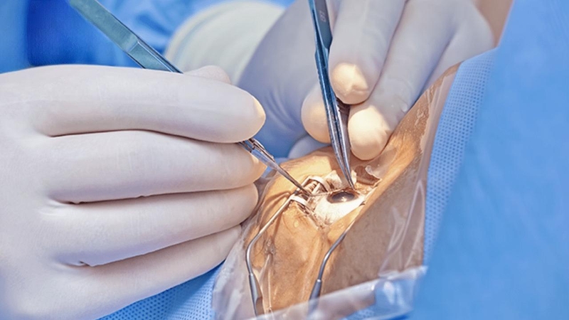 Mắt mờ sau mổ phaco là do đâu? Có cách nào khắc phục không? 1