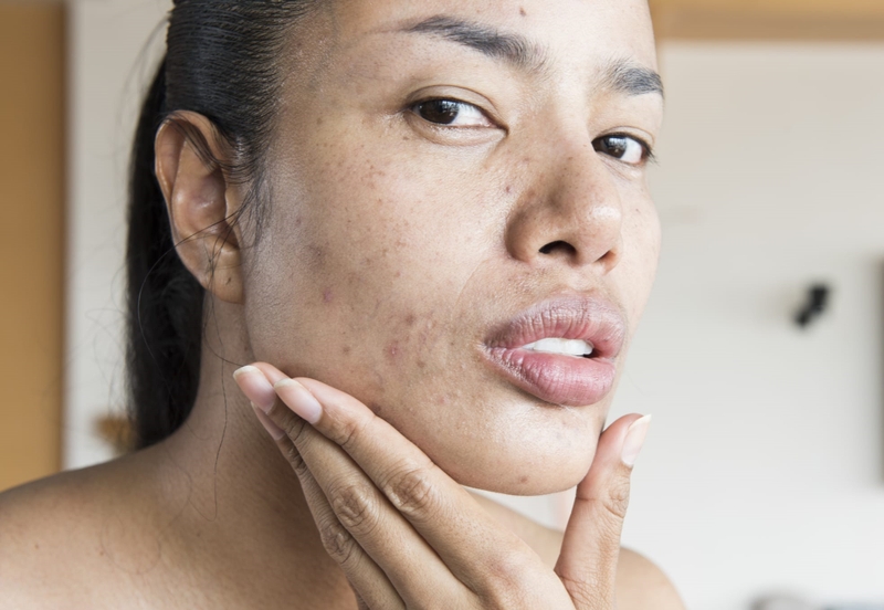 Mặt mụn có nên dùng nước tẩy trang hay không 2