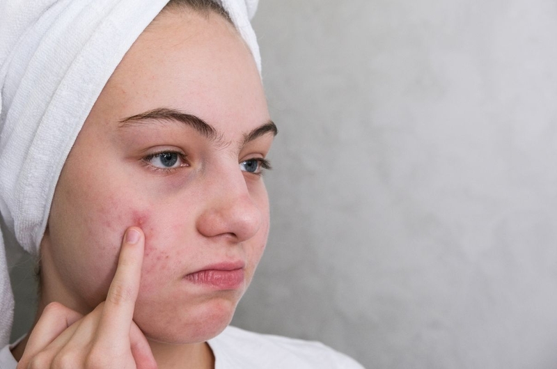 Mặt nạ đất sét có đẩy mụn không 3