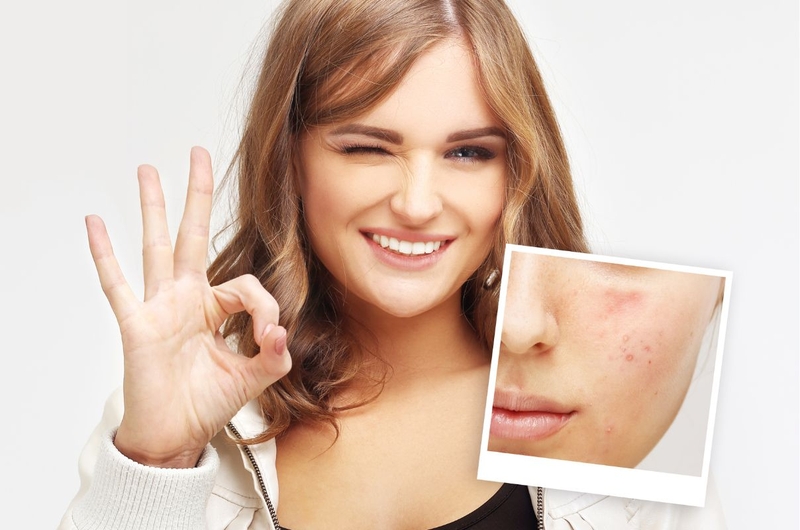 Mặt nạ đất sét có đẩy mụn không 4