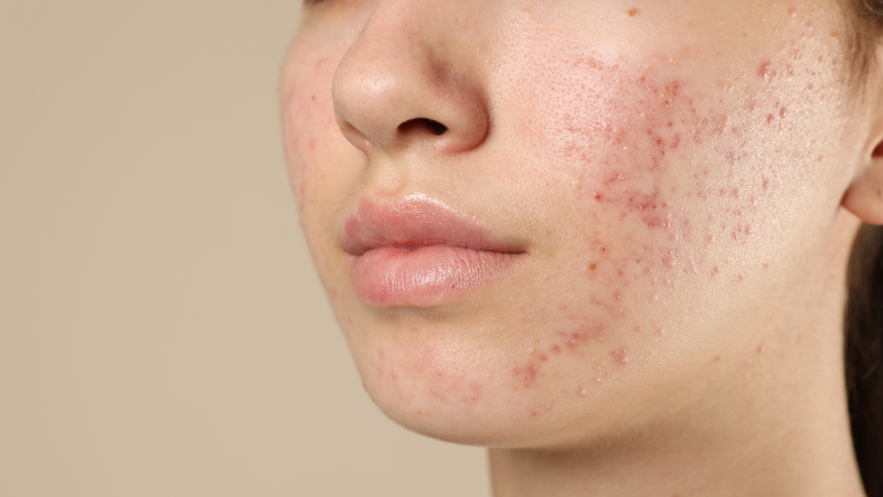 Nhiều người thắc mắc mặt nổi mụn có phải dấu hiệu mang thai sớm không