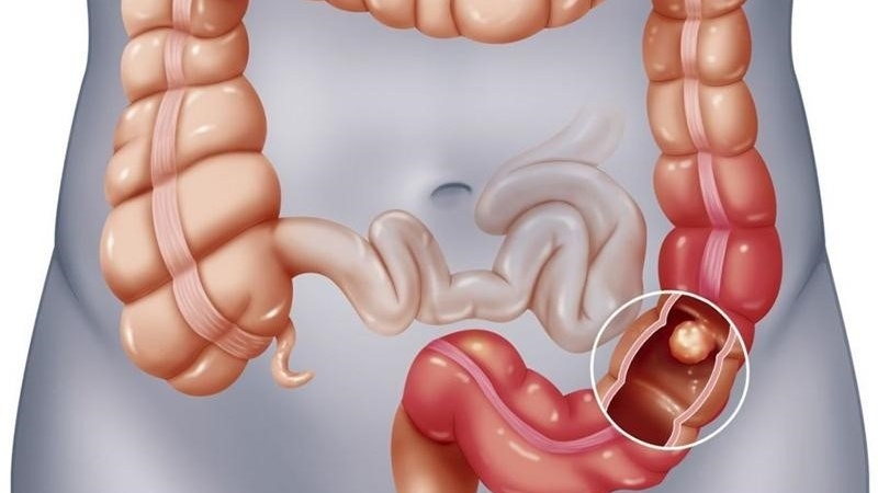 Mật ong - Liệu pháp tự nhiên hiệu quả trong việc chữa viêm đại tràng 1