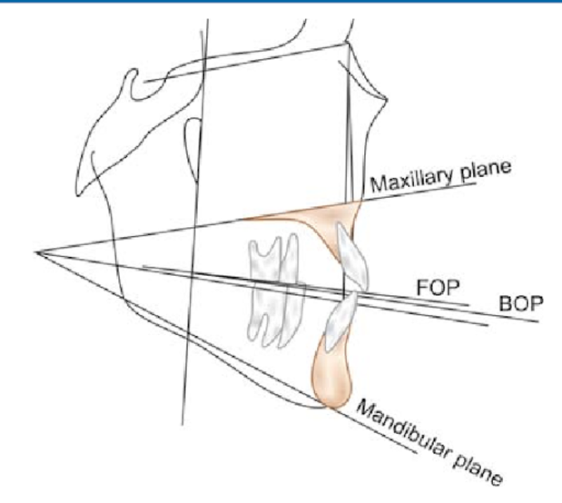 mat-phang-camper-va-mot-so-mat-phang-su-dung-pho-bien-trong-nha-khoa 1.png