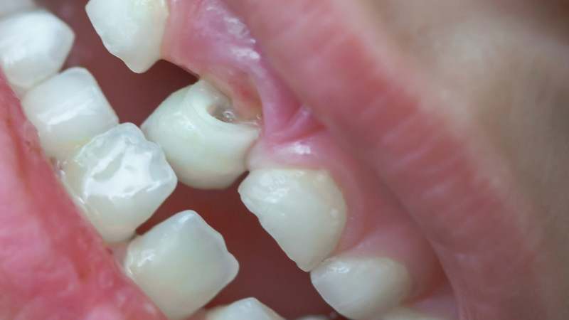 Mất răng bao lâu thì bị tiêu xương hàm?