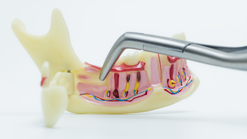 Khi một chiếc răng mất đi, khoảng trống còn lại khiến các răng bên cạnh có xu hướng hư tổn
