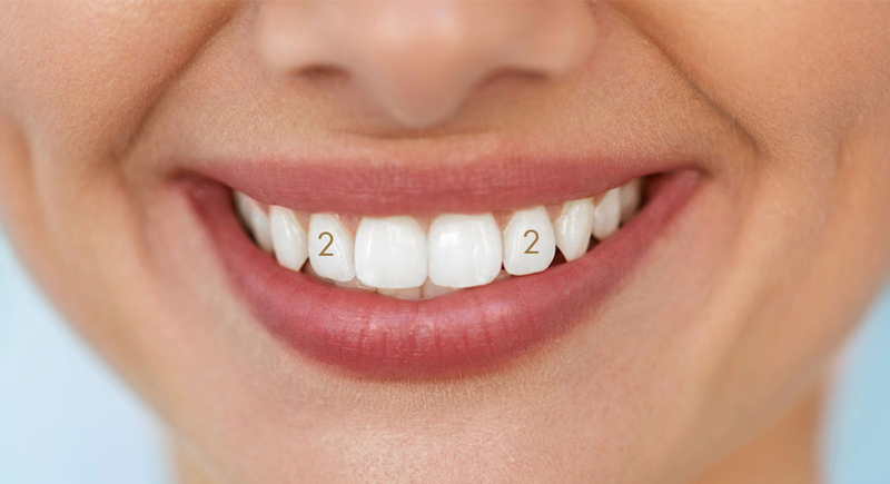 Mất răng số 2 có ảnh hưởng gì không?1