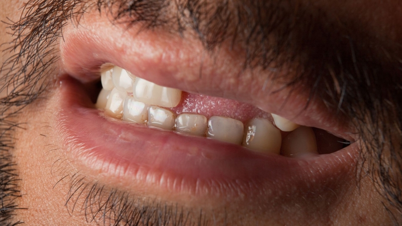 Mất răng số 2: Hậu quả và cách xử lý 2