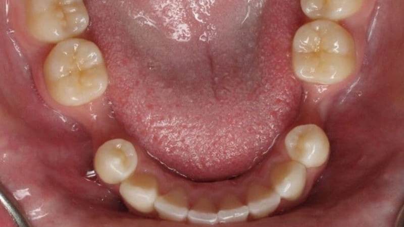 Mất răng số 5 có niềng được không&nbsp;phụ thuộc nhiều yếu tố