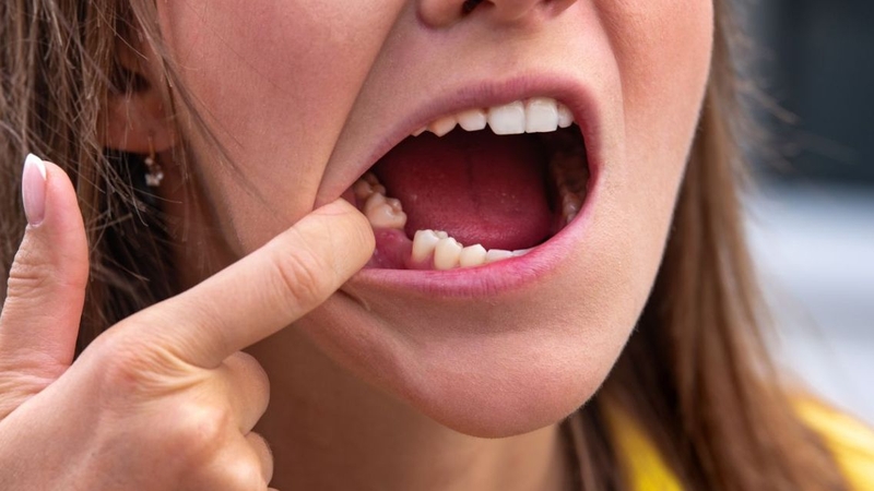 Niềng răng khi mất răng số 5 có độ phức tạp cao