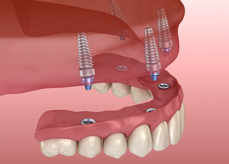 Mất răng số 7 có niềng răng được không 3