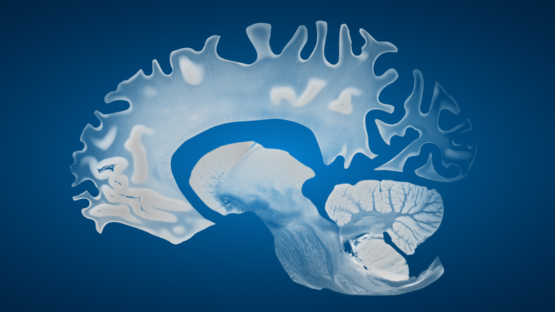 Mất thính lực đẩy nhanh tốc độ teo não và làm suy giảm nhận thức nghiêm trọng