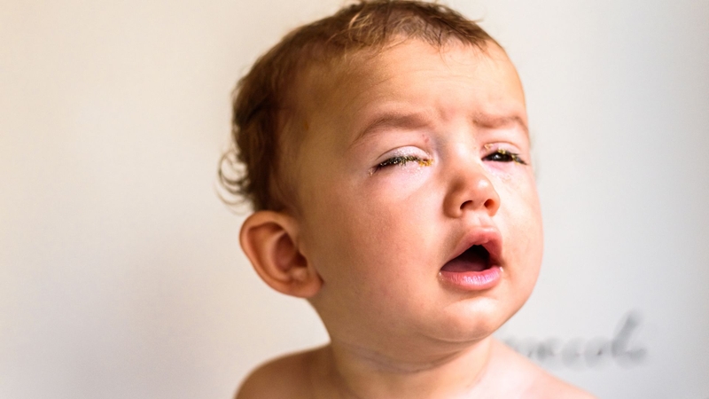 Tắc tuyến lệ thường gây chảy nước mắt, ghèn và có thể khiến mắt đỏ khi bội nhiễm