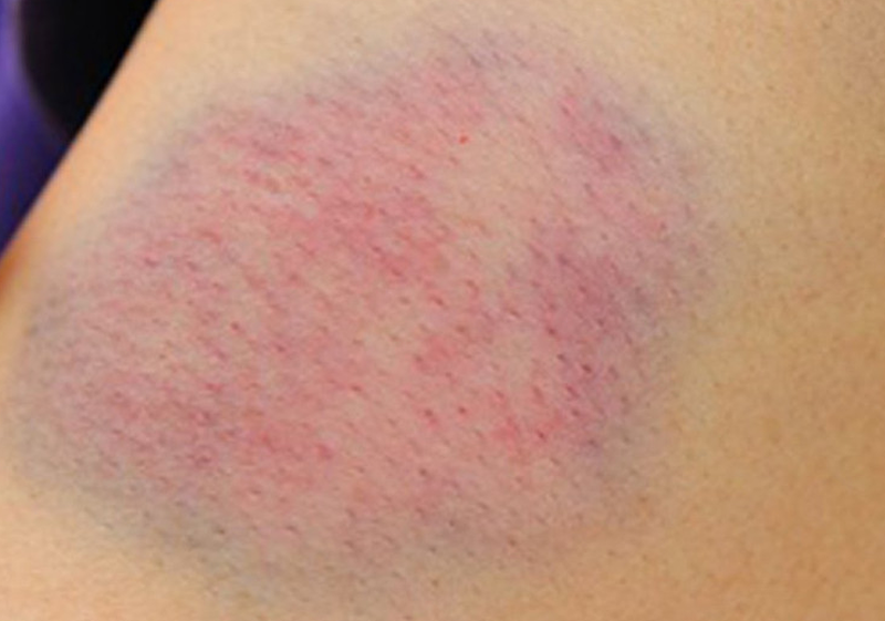 Máu loãng là nhóm máu gì? Có điều trị dứt điểm được không? 2