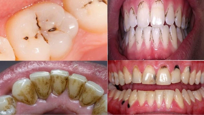 Răng chuyển sang màu đen báo hiệu vấn đề sức khỏe