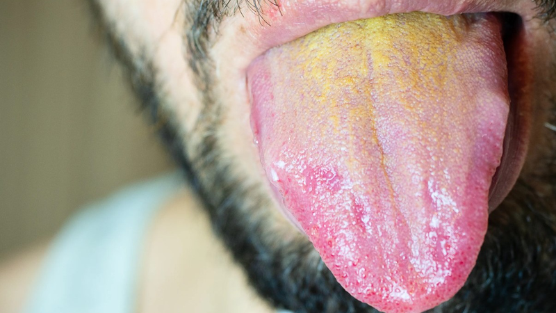 Màu sắc của lưỡi nói lên điều gì? 3