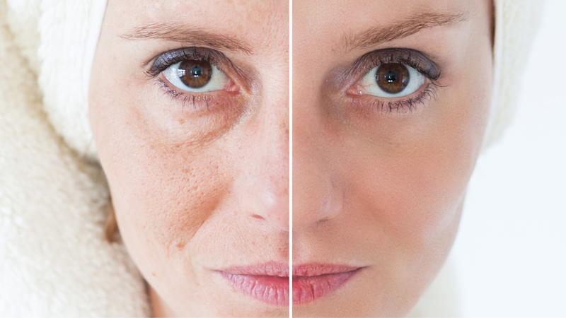 Máy HIFU là gì? Có công dụng gì? 2