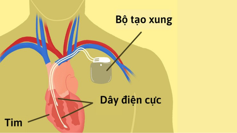 Máy tạo nhịp tim có an toàn không? 2