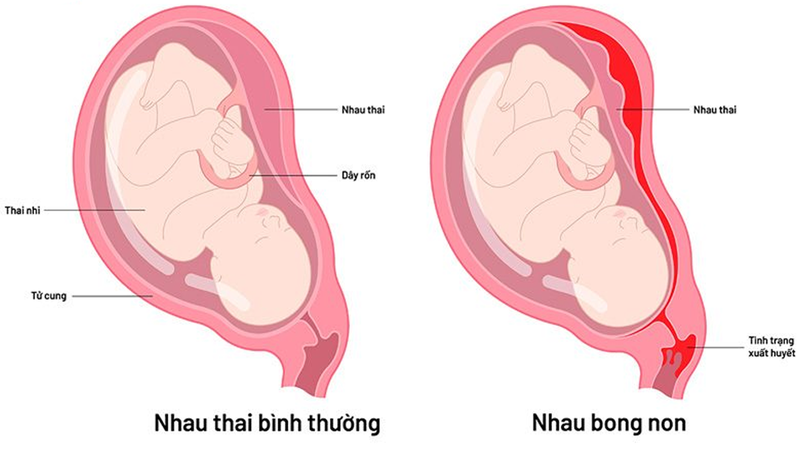 me-bau-bi-bong-nhau-non-3-thang-cuoi-do-dau-2.jpg.png