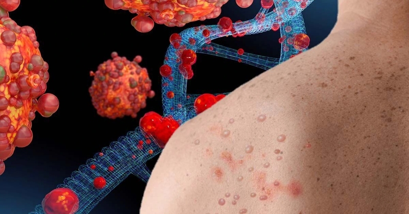 Mẹ bầu bị đậu mùa khỉ có nguy hiểm đến sức khỏe thai nhi không? 1