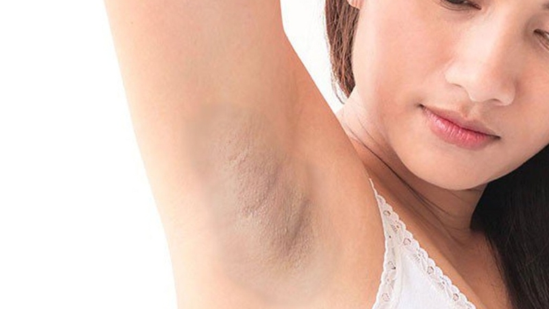 Mẹ bầu bị thâm nách có sao không? Cách xử trí an toàn, lành tính giúp chị em tự tin hơn 1