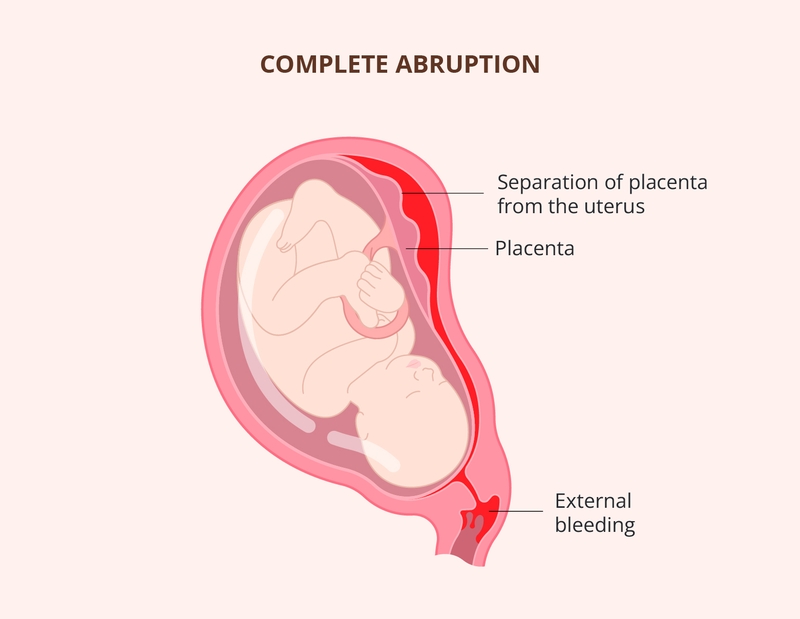 Mẹ bầu cần đọc ngay: Ra máu nâu khi mang thai 5 tuần cảnh báo điều gì? 3