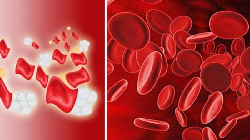 Bị thiếu máu thừa sắt nên ăn gì để cải thiện sức khỏe? 1