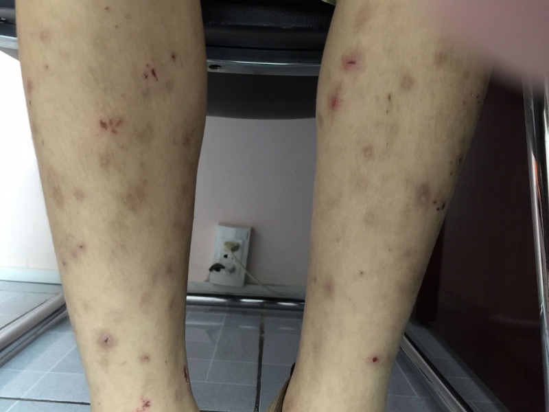 Mề đay sán chó: Biểu hiện và cách chữa trị 3