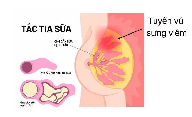 Mẹ mới sinh không có sữa phải làm sao? Lời khuyên từ chuyên gia 4