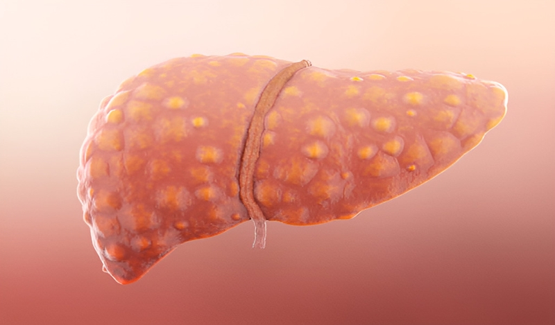 Men gan cao có bị viêm gan B không? Cách giảm men gan để bảo vệ sức khỏe 1