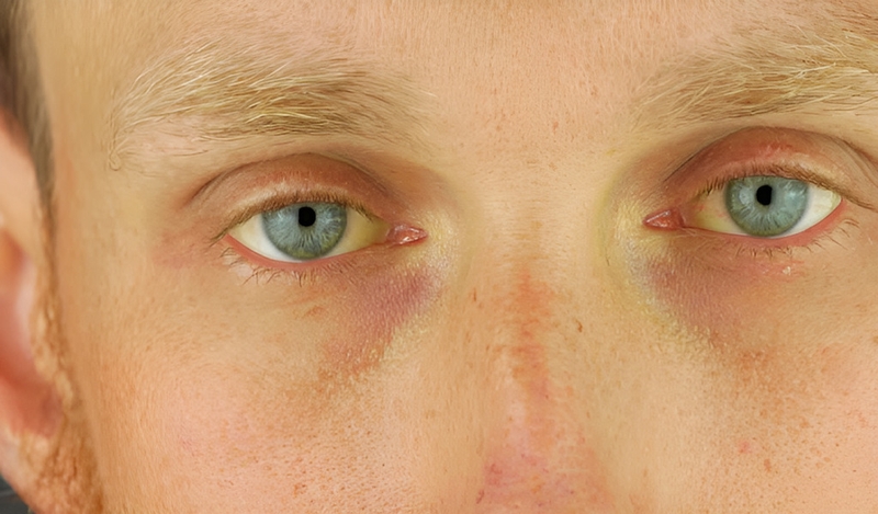 Men gan cao có bị viêm gan B không? Cách giảm men gan để bảo vệ sức khỏe 2