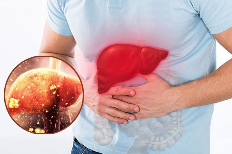 Bệnh men gan cao có lây không? Cách phòng tránh men gan cao hiệu quả? 1