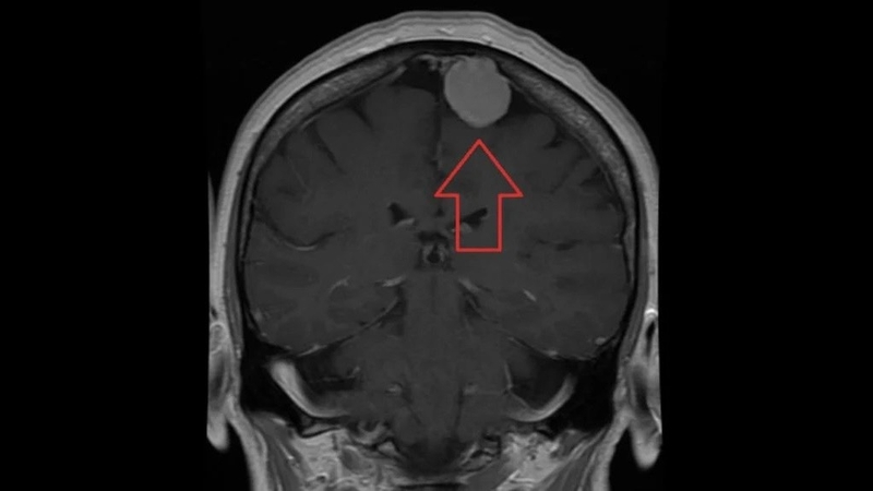 meningioma-la-gi-nhung-tac-dong-cua-meningioma-den-suc-khoe 3
