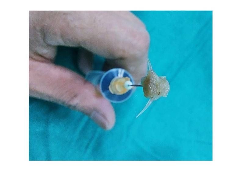 mẹo chữa hóc xương cá 4