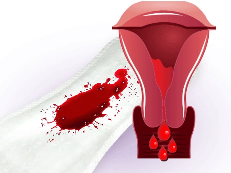 Mẹo chữa rong kinh bằng gừng đơn giản, hiệu quả dành cho chị em phụ nữ 1