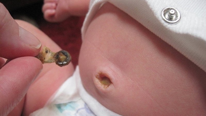 Mẹo dân gian khi trẻ rụng rốn không phải ai cũng biết 3