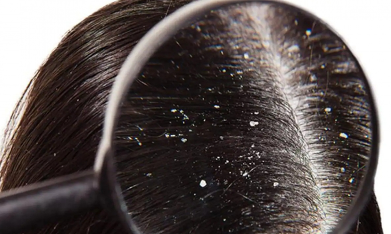 Mẹo dùng Gynofar gội đầu trị hết gàu hiệu quả 1