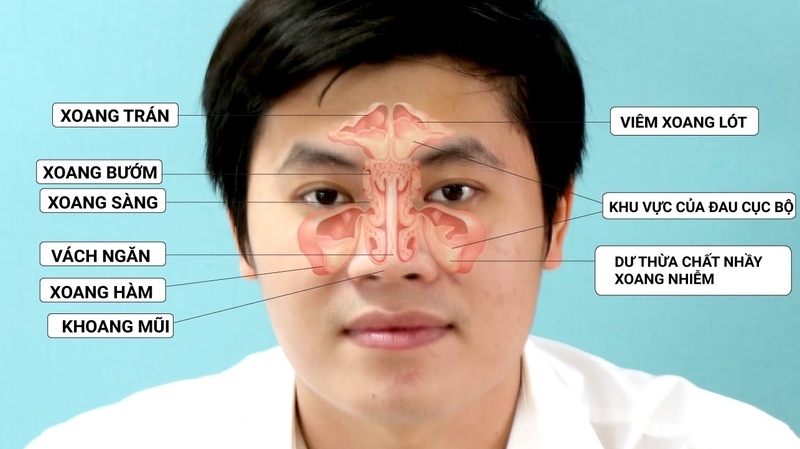 Mẹo dùng rượu tỏi chữa viêm xoang hiệu quả 3