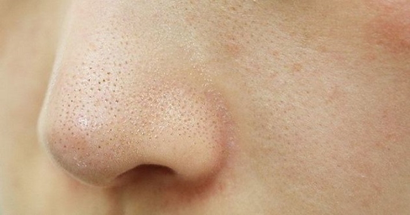 Mẹo làm đẹp đơn giản: Cách lấy sợi bã nhờn bằng Vaseline2