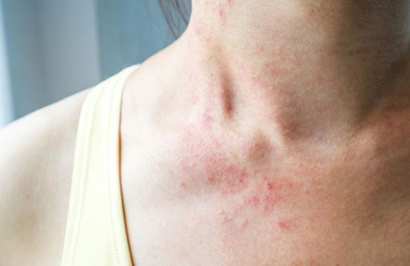 Mẹo trị dị ứng hải sản bạn cần biết2